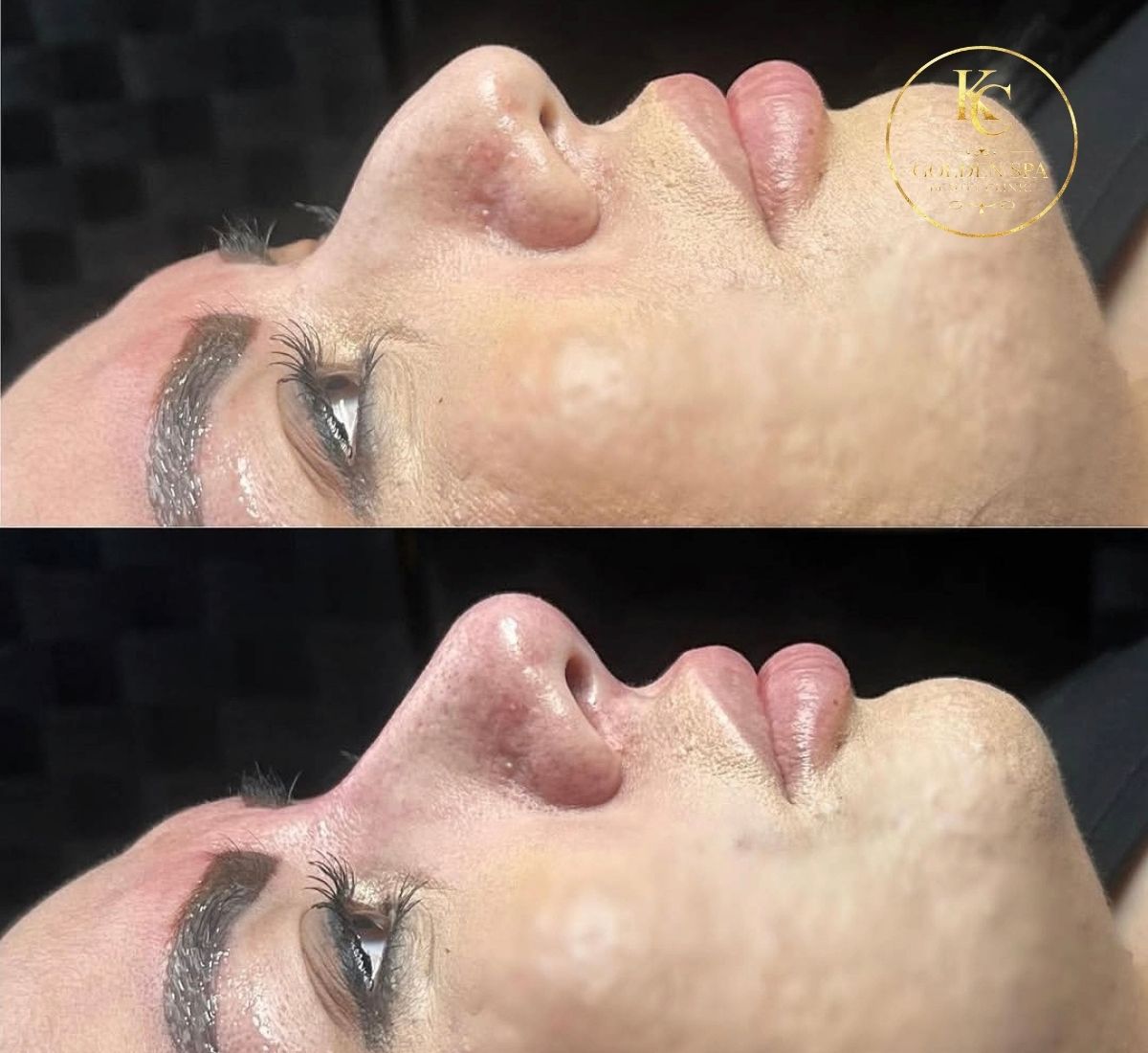 Nose Filler