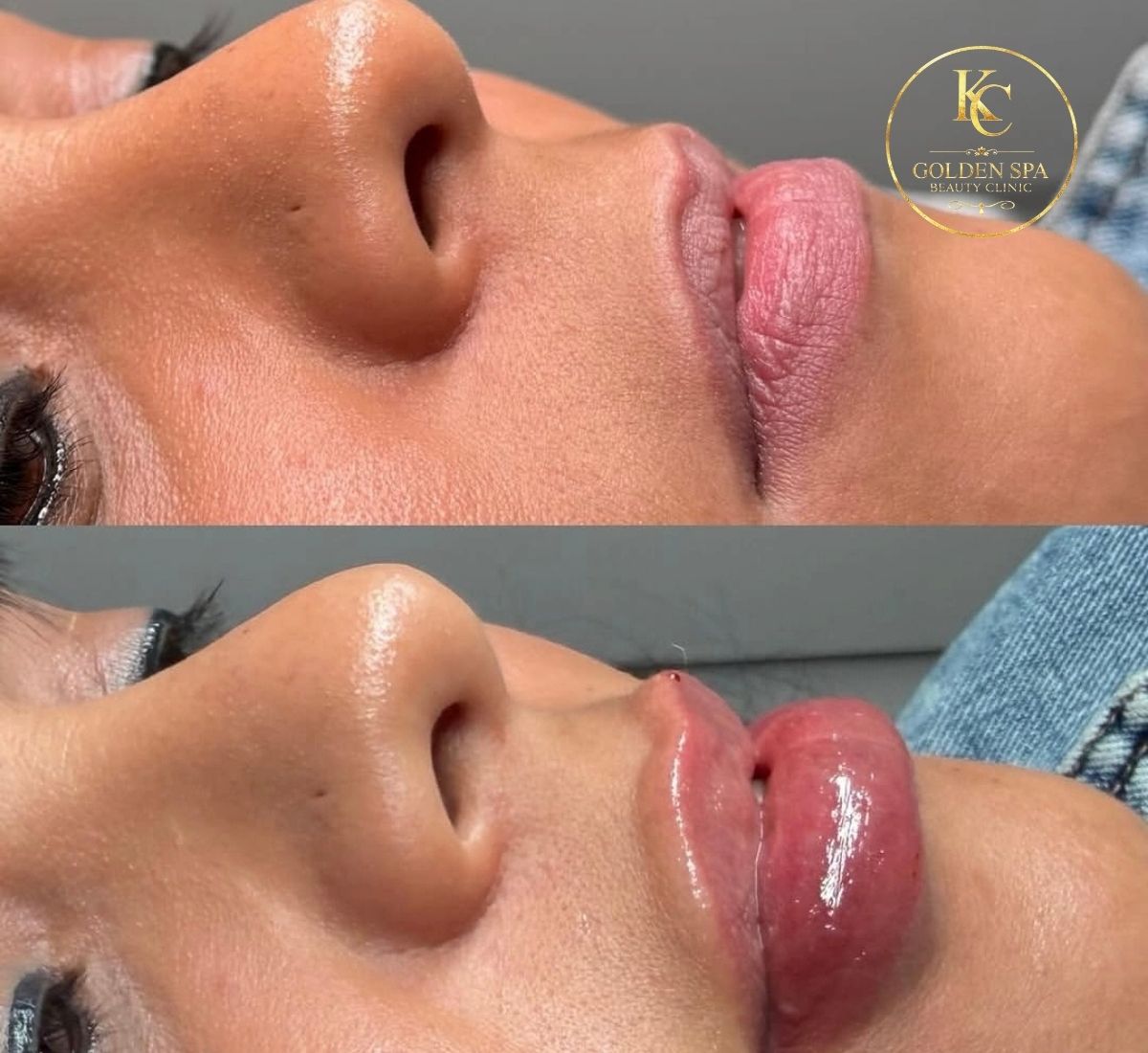 Lip Filler Result