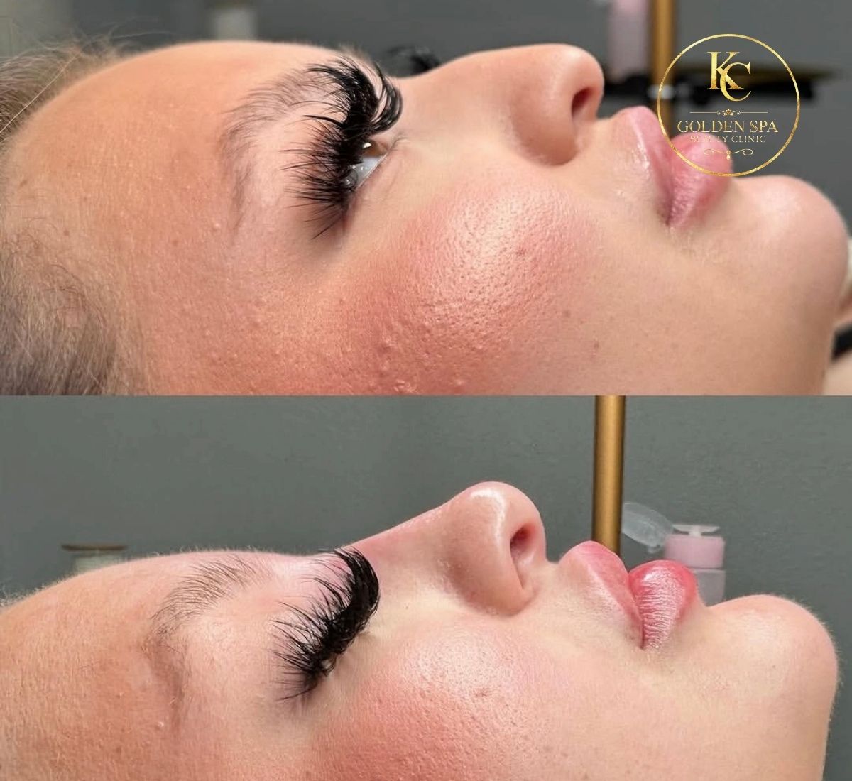 Nose & Lips Result