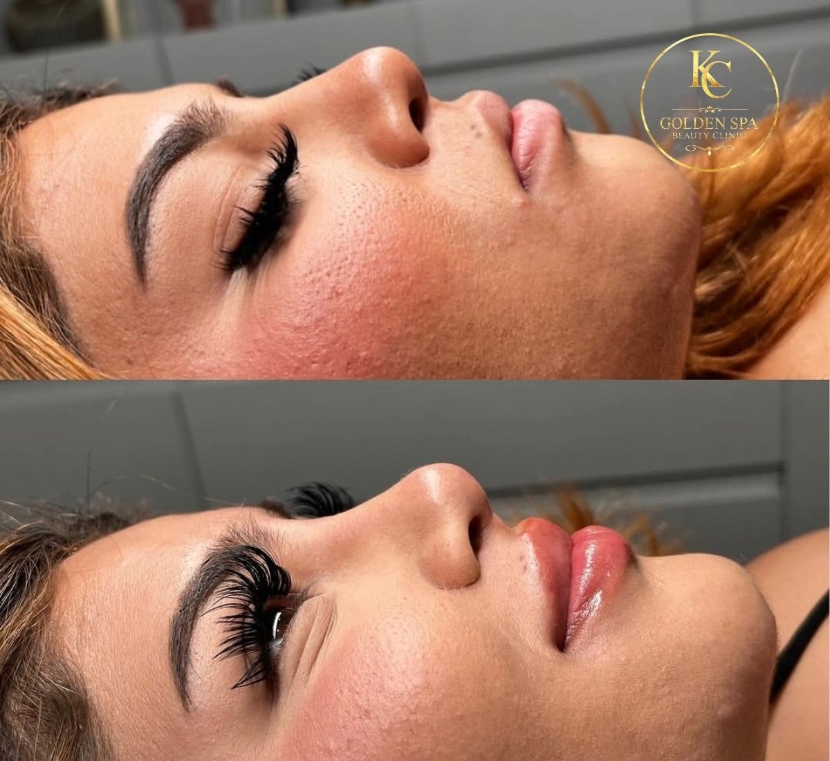 Nose & Lips Result