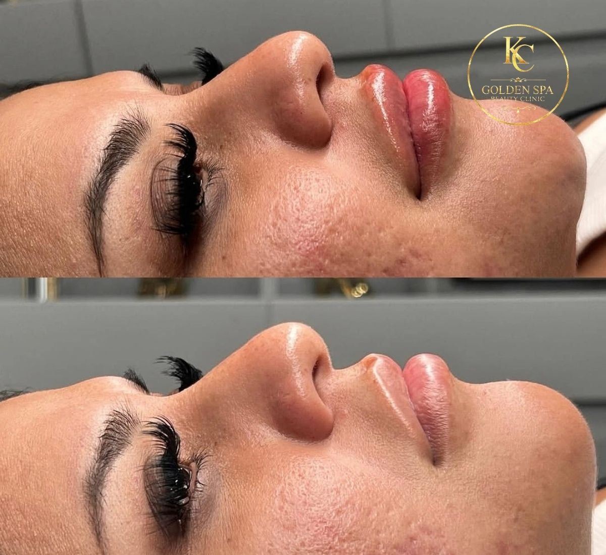 Lip Filler Result