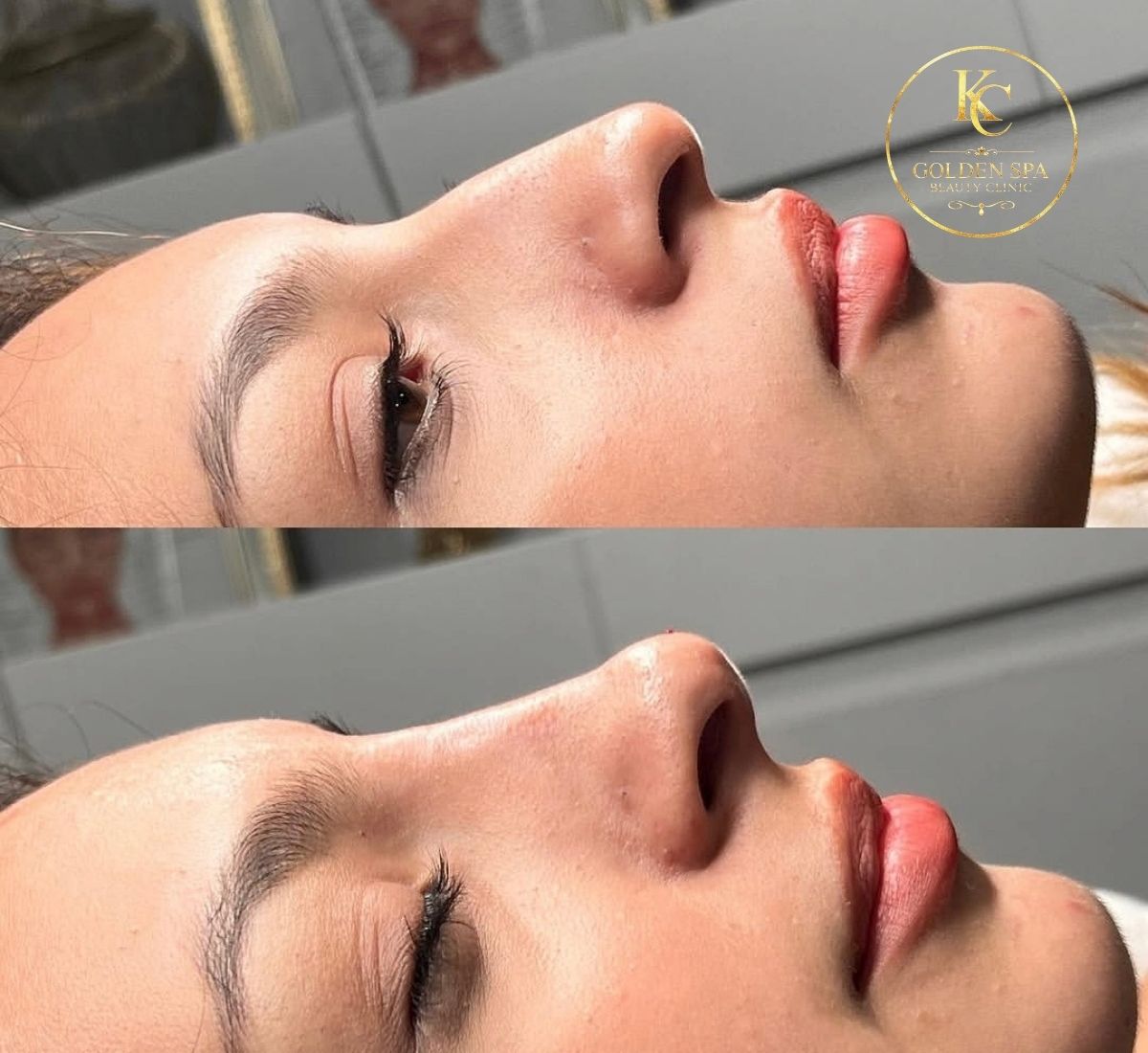 Nose Filler