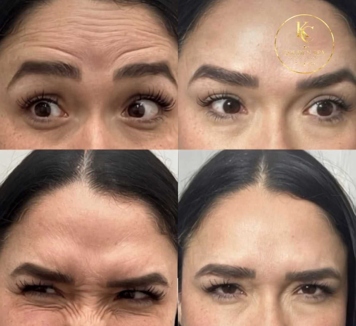 Botox Result