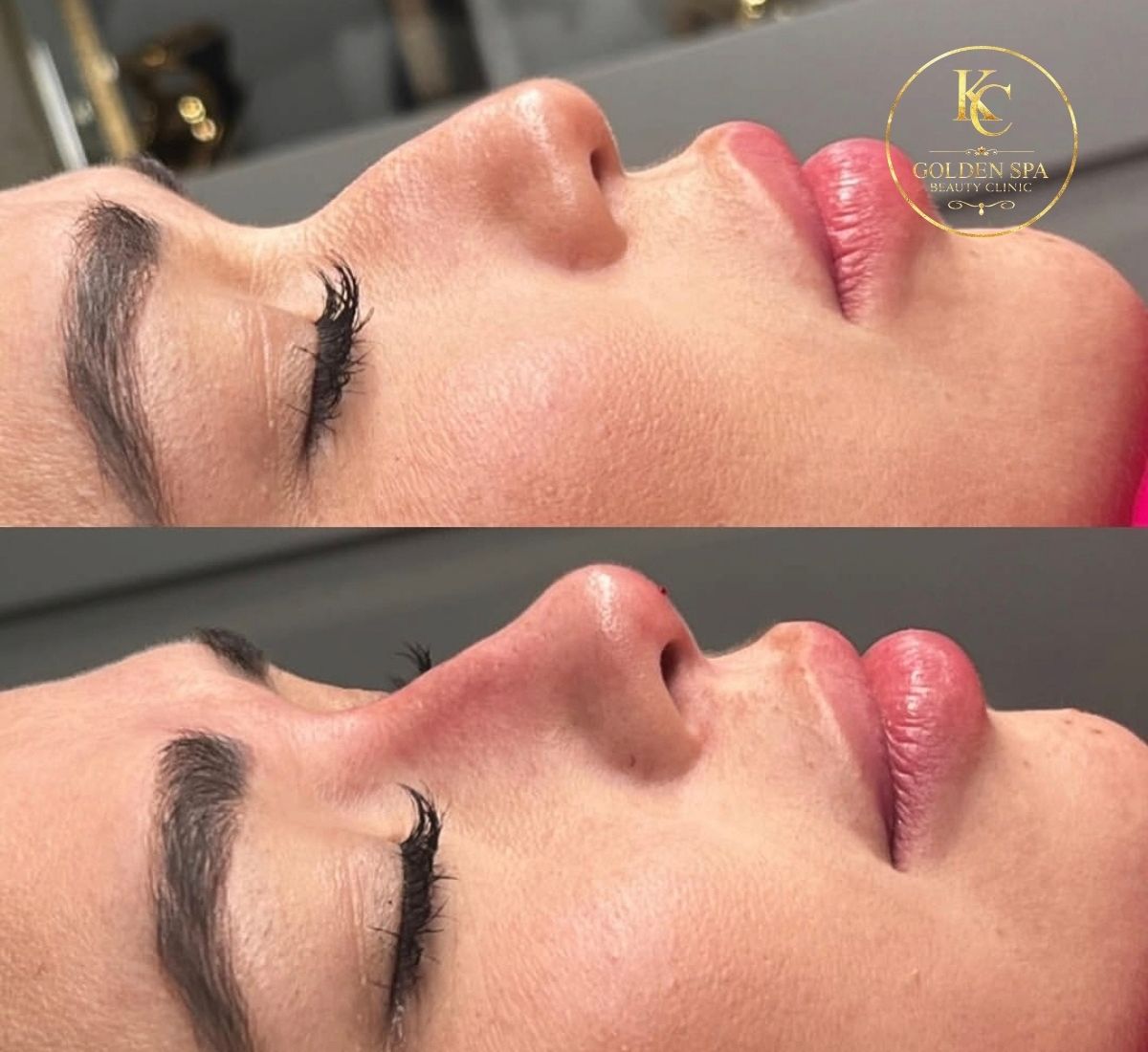 Nose Filler